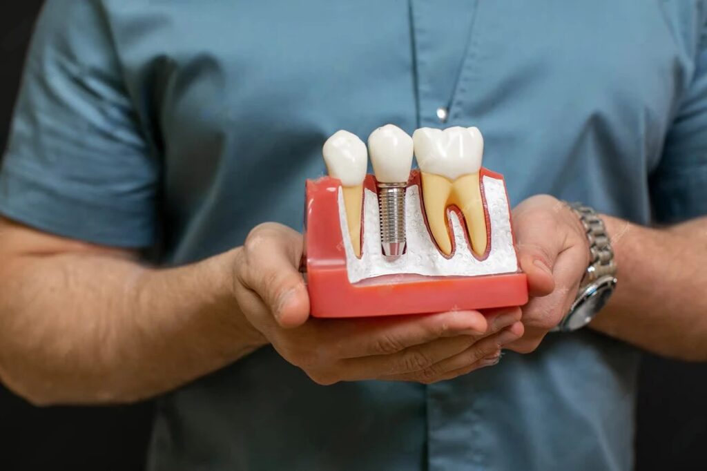 Dental implants