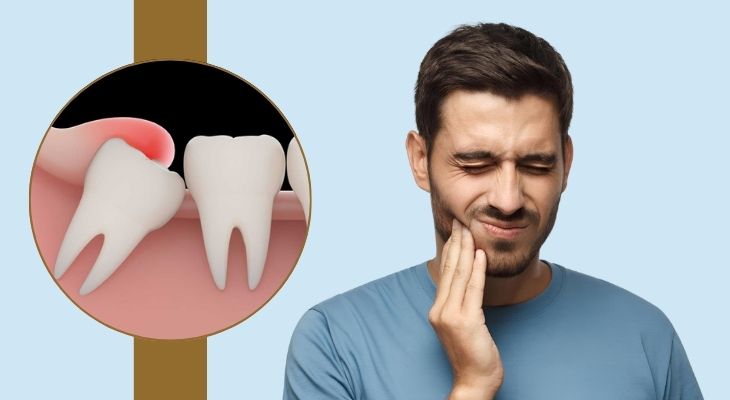 wisdom tooth extraction cost Cheshire