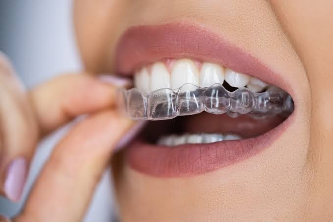 How Invisalign Helps Correct Misaligned Teeth Comfortably 